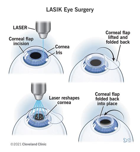 laser eye surgery huddersfield|The Best 10 Laser Eye Surgery/Lasik near Huddersfield HD3.